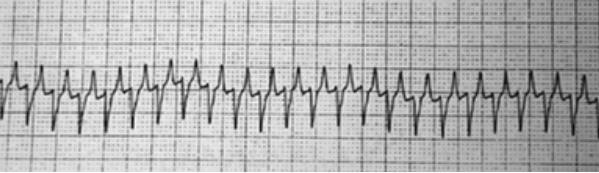 17 Figura 7 - Eletrocardiograma de um gato obstruído e com hipercalemia. Eletrocardiograma de um gato obstruído com concentração sérica de potássio acima de 9 meq/l.