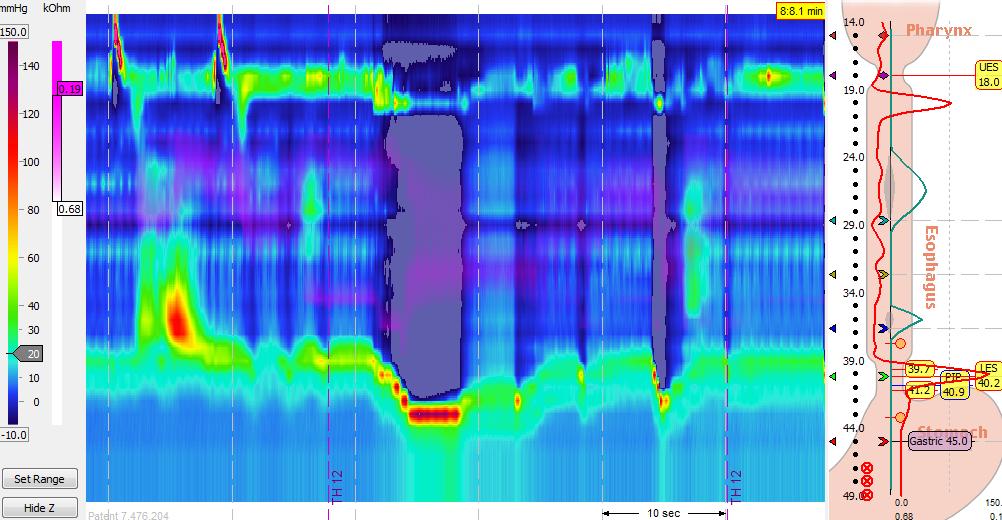 17 Figura 6 Imagem de manobra de arritmia sinusal respiratória, à manometria de alta resolução.