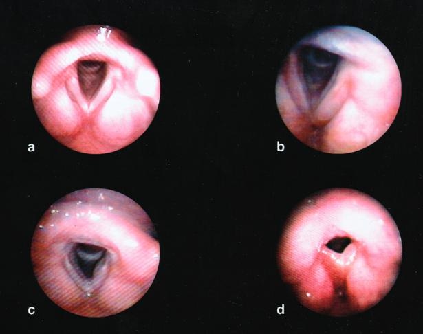 21 Fig 11. Edema de prega vocal à videolaringoscopia. (a) edema leve. (b) edema moderado.