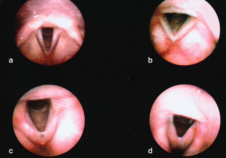 Hipertrofia de comissura posterior à videolaringoscopia. (a) comissura posterior normal.