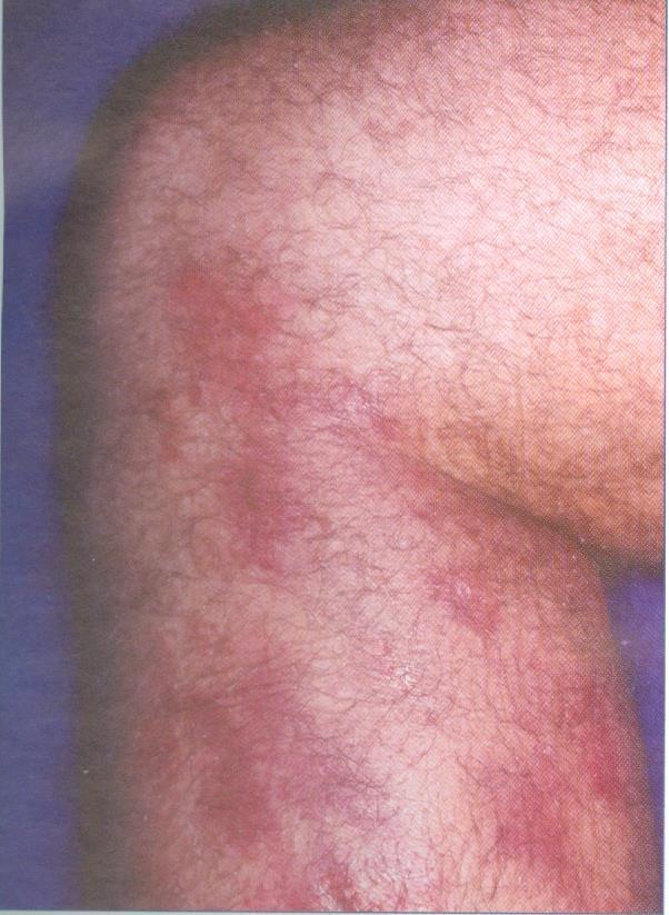 Figura 1. Eritema. (Fonte: Azulay DR. Lesões elementares e semiologia dermatológica.