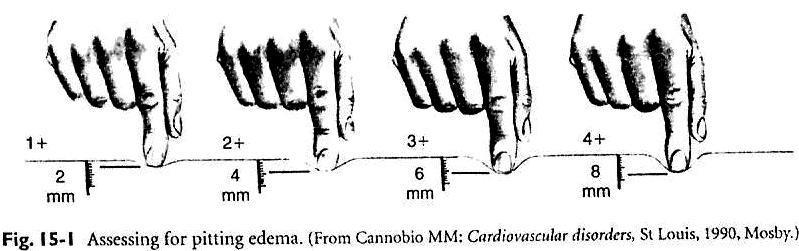 7. Edema* AVALIAÇÃO DA PELE Exame e Documentação 0+ = sem edema com depressão 1+ = leve (desaparece rapidamente) 2+ = moderada (10 a 15 segundos)