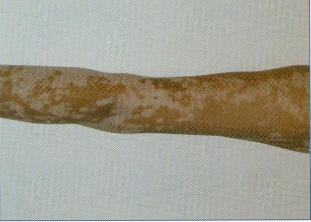 Figura 2. Mancha acrômica. (Fonte: Azulay DR. Lesões elementares e semiologia dermatológica.