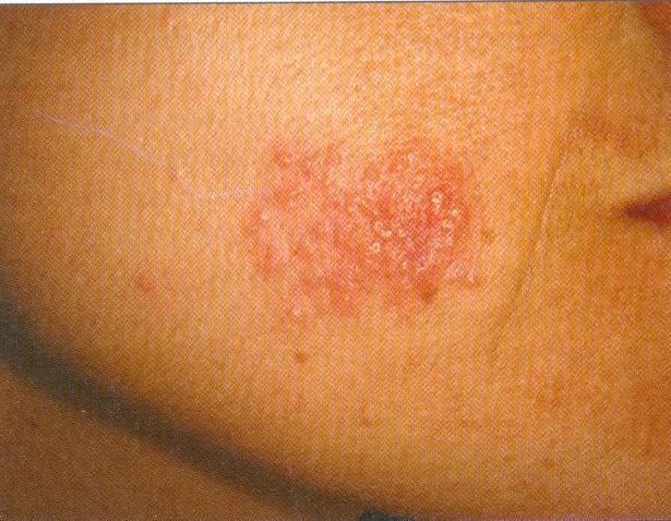 Figura 10. Vesículas. (Fonte: Azulay DR. Lesões elementares e semiologia dermatológica.