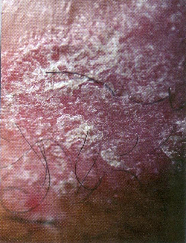 Figura 13. Escama. (Fonte: Azulay DR. Lesões elementares e semiologia dermatológica.