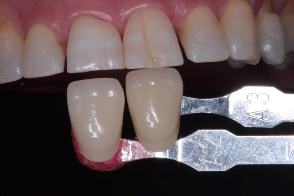 15 Quanto à arcada inferior a cor inicial foi: A2 na incisal e A3 na cervical dos dentes anteriores. Figura 2. Registro da cor inicial.