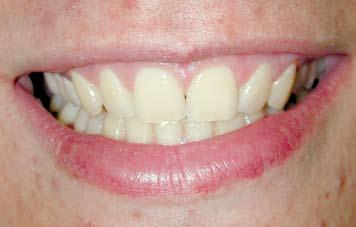 Avaliação clínica da eficiência do uso do sistema LED/laser, LED e luz halógena na ativação do agente clareador em dentes vitalizados Figura 1 - Aspecto inicial do sorriso.