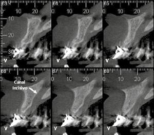tualidades em mplantodontia CNL NCSV - FRME NCSV canal incisivo é um canal que abriga nervos e vasos, localizado na região anterior do palato duro, com direção descendente, anterior e medial,