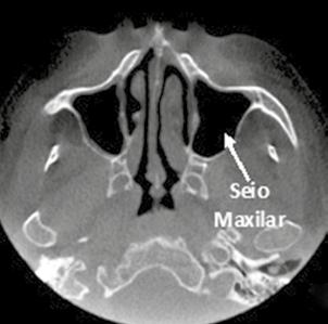 correto estudo através de imagens desta área previne surpresas com alterações anatômicas e possíveis lesões do seio maxilar.