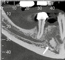 incisiva do canal mandibular (setas