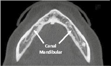 tualidades em mplantodontia CNL MNDULR É o conduto que aloja o nervo alveolar inferior e seus