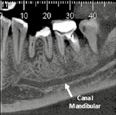 Radiograficamente é radiolúcido / hipodenso e limitado por suas corticais que são radiopacas /