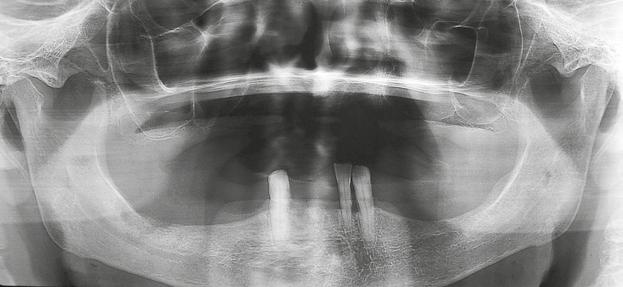 tualidades em mplantodontia PRESENÇ DE DENTES Pontas das raízes, dentes impactados, ou outras condições