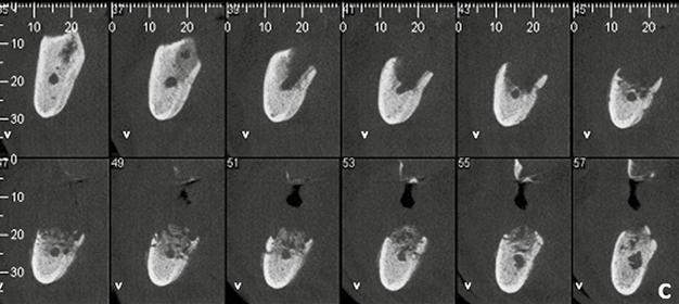 Radiografia panorâmica evidenciando a osteonecrose associada aos bifosfonatos na região posterior de
