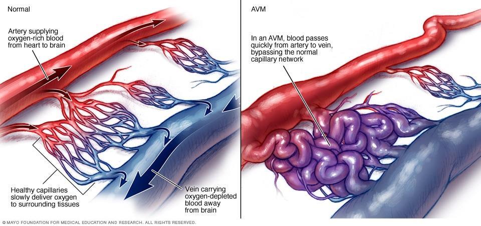 O que são MAVs Malformação congênita composta de conglomerado vasos malformados sem leito capilar, com shunt arteriovenoso Drenagem venosa