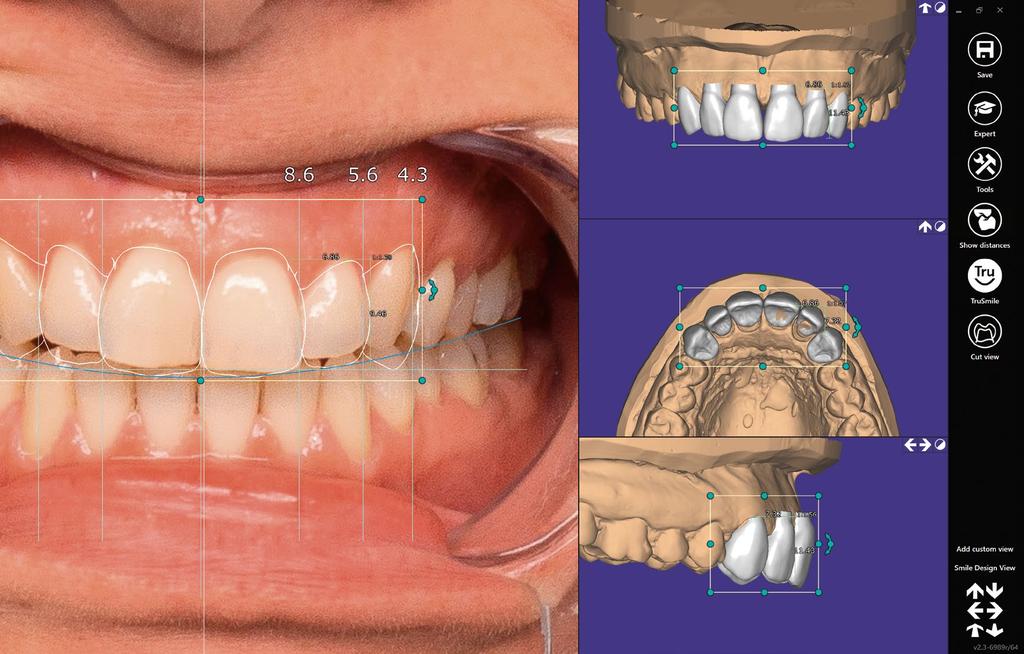 4 Smile Creator Smile Creator 5 Visionário, versátil, útil Seu desenho de sorriso integrado com Smile Creator in-cad Crie valor agregado com o Smile Creator a solução inovadora smile design in-cad da