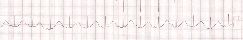 de 0.66ms Realiza ecocardiograma que foi normal e o ECG de repouso mostrou um intervalo QT Figura 9 Ritmo Sinusal: QT-0.66 ms, QTc- 0.728 ms Iniciou tratamento com propranolol.