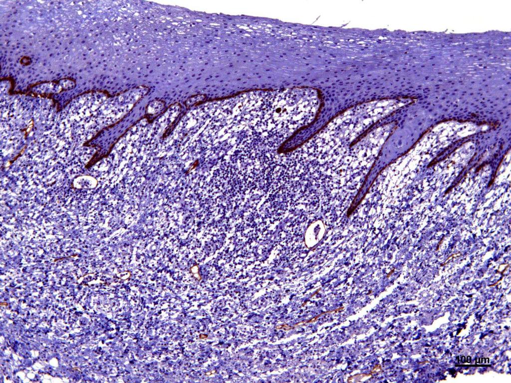 5 Resultados 117 A B Figura 6 - Expressão imuno-histoquímica de podoplanina nas células da camada basal do