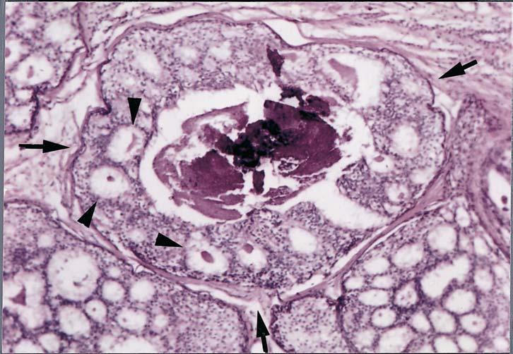 Calcificações arredondadas como único achado mamográfico no carcinoma da mama micropapilares, cribriformes e papilíferos, por terem cavidades arredondadas, darão origem a calcificações com esta forma.