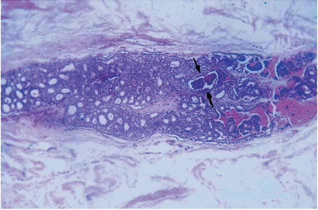 Em, corte histológico mostrando lóbulo cancerizado por CDIS tipo cribriforme/micropapilar (setas) com calcificações no interior das cavidades arredondadas (cabeças de setas).