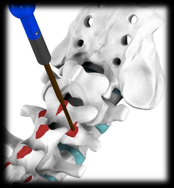 do pedículo será compactado. O osso osteoporótico da cortical do pedículo apresenta risco aumentado de ruptura pelo Prob/Medidor de Profundidade em todos os planos.