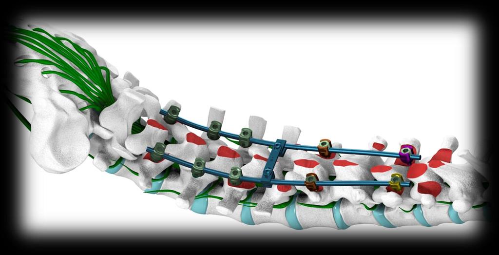 O Sistema de Fixação de Coluna Spine Implantes - Spinelock também conta com Conectores de Haste, Extensores DTT e Hastes Longitudinais CoCrMo