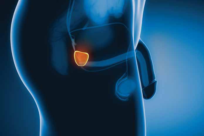 Câncer de Próstata A abordagem diagnóstica da doença se baseia no rastreamento do indivíduo com exame clínico urológico e dosagem do Antígeno Prostático Específico (PSA).