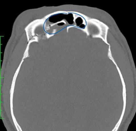 31 C. Grande: imaginologia evidenciando seio frontal estendendo-se desde a porção mais lateral da extensão rebordo