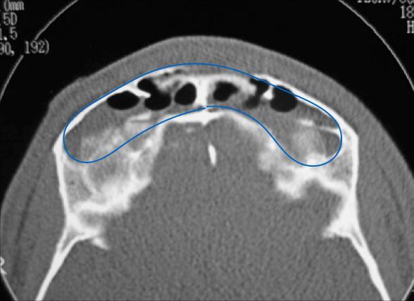 33 Figura 5 - Exemplo tomográfico, corte axial, mostrando um tamanho de seio frontal definido como grande Fonte: Elaboração própria. 4.