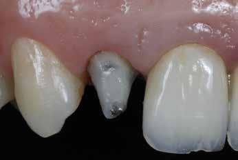 9a). Foi realizado exame clínico radiográfico (Fig. 9b) e tomográfico. Observou-se a presença de lesão periapical com extensa perda óssea, o que indicava a necessidade de cirurgia periapical.