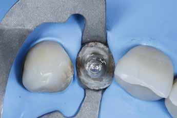 A remoção da coroa foi realizada cautelosamente utilizando-se ultrassom e uma pinça hemostática (Fig. 10). O dente 12 foi anestesiado e isolado com lençol de borracha e grampo 212 modificado (Fig.