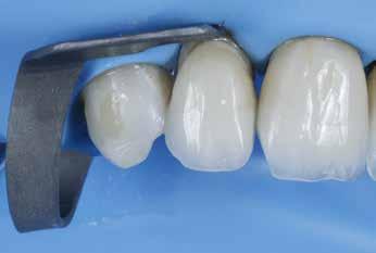 QUANDO REALIZAR A REMOÇÃO DE RETENTORES INTRARRADICULARES? Figuras 16a-b: Coroa cimentada, sendo utilizada como restauração provisória. Figura 16b. Figura 16c: Radiografia periapical final do dente12.