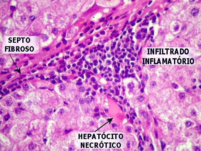 3. Vírus da Hepatite B Etiopatogenia O vírus usa a maquinaria enzimática do hospedeiro