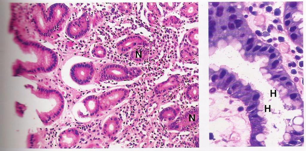 4. Helicobacter pylori Etiopatogenia É das infecções mais comuns Gastrite aguda gastrite crónica Fig.