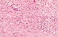 Diferenciação e Anaplasia Critérios de malignidade Leiomioma do útero Fig.