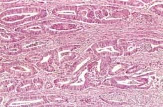 Diferenciação e Anaplasia Critérios de malignidade Tumor maligno (adenocarcinoma) do cólon Fig.