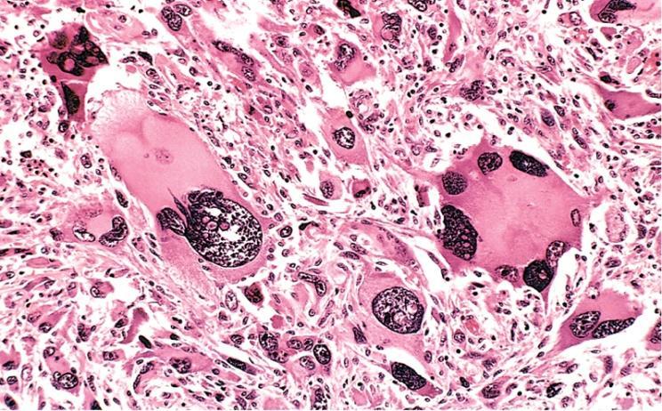 Diferenciação e Anaplasia Critérios de malignidade Tumor anaplásico do músculo esquelético (rabdomiosarcoma) Fig.