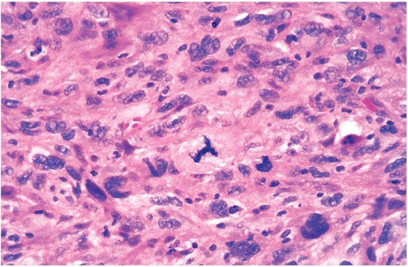 Diferenciação e Anaplasia Critérios de malignidade Tumor anaplásico, mostrando variação celular e nuclear no tamanho e na forma