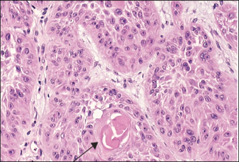 Diferenciação e Anaplasia Critérios de malignidade Carcinoma escamoso da pele bem diferenciado Fig.