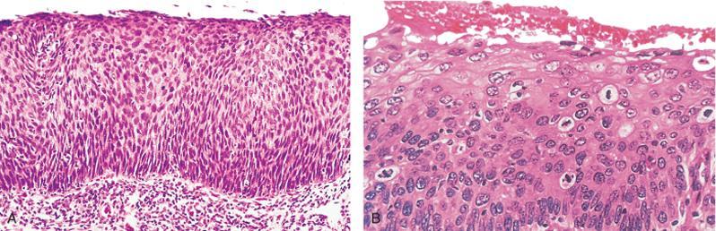 Diferenciação e Anaplasia Critérios de malignidade Carcinoma in situ e pormenor aumentado de regiões pouco diferenciadas