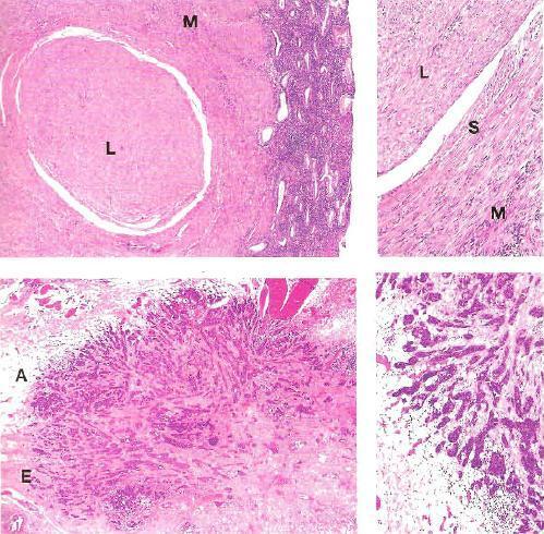 Invasão local Critérios de malignidade Fig. 22 e 23 neoplasia benigna do m.