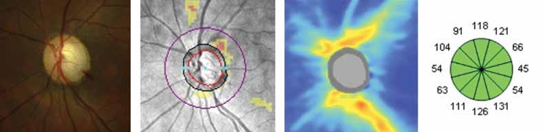superioridade da avaliação da espessura da CFN PP, medida pelo aparelho Spectralis, quando comparada à análise da rima neural, obtida por Heidelberg retina tomography (HRT).