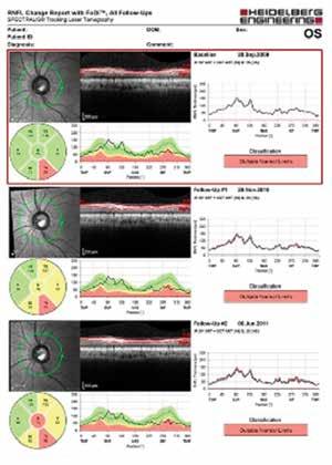 Atualmente, a última versão do aparelho, Triton OCT, possui software com análise de tendência para a avaliação de progressão do glaucoma.