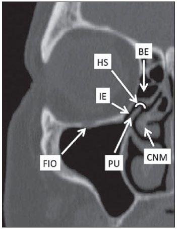 Figura 3 - Imagem no plano coronal demonstrando os componentes e relações anatômicas da unidade ostiomeatal.