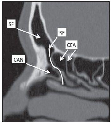 Figura 5 - Anatomia do recesso frontal (RF) no plano sagital e sua relação com as células etmoidais anteriores (CEA). Em destaque: a célula de agger nasi (CAN) e o seio frontal (SF).