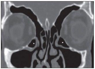 Figura 7 - Célula de Haller (asteriscos). Células etmoidais que se pneumatizam inferiormente às órbitas para o interior dos seios maxilares.