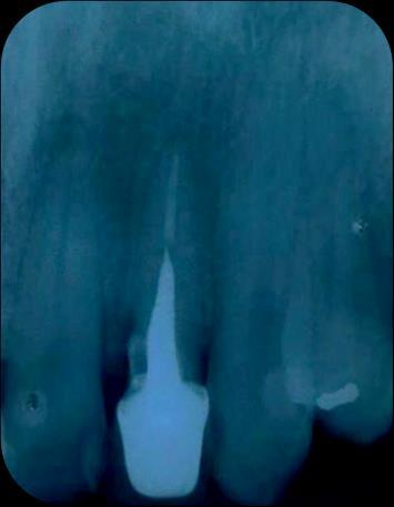 resistência radicular à fratura após a cimentação da prótese fixa com retentor intrarradicular (Figura 8). Figura 8 Radiografia de proservação 1 ano.