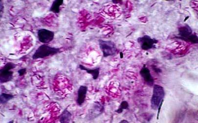 Mycobacterium leprae: Viável em secreções nasais secas fora do organismo 7 dias Infecta o endotélio vascular, macrófagos Células de Schwan Multiplica-se por divisão binária 11 a 16 dias