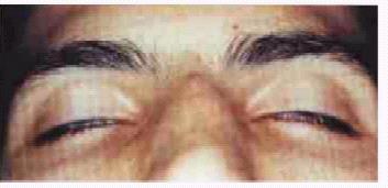 Lagoftalmo Inicial - Conceito - incapacidade parcial de ocluir os olhos pela diminuição da força do músculo orbicular - Sinais e Sintomas -