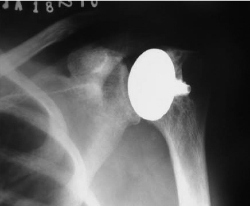 As radiografias pós-operatórias após revisão mostraram sólida fixação dos componentes sem qualquer sinal de radioluscência ou evidência de migração do implante.